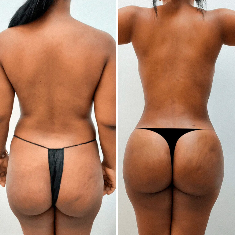 Brazilian Butt Lift (BBL) procedure at Juventus Cosmetic Surgery in Miami: A close-up view of a patient consulting with a certified plastic surgeon. The surgeon is explaining the BBL process using diagrams and a 3D model of the buttocks. The patient looks attentive and engaged. The background shows a modern, well-equipped medical office with certificates on the wall, indicating the surgeon's qualifications.