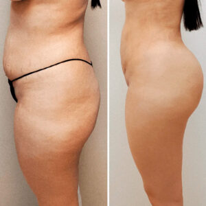 Brazilian Butt Lift (BBL) procedure at Juventus Cosmetic Surgery in Miami: A close-up view of a patient consulting with a certified plastic surgeon. The surgeon is explaining the BBL process using diagrams and a 3D model of the buttocks. The patient looks attentive and engaged. The background shows a modern, well-equipped medical office with certificates on the wall, indicating the surgeon's qualifications.