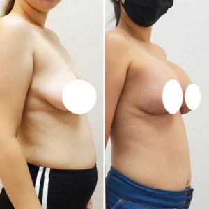breast-lift-miami-price-before-and-after