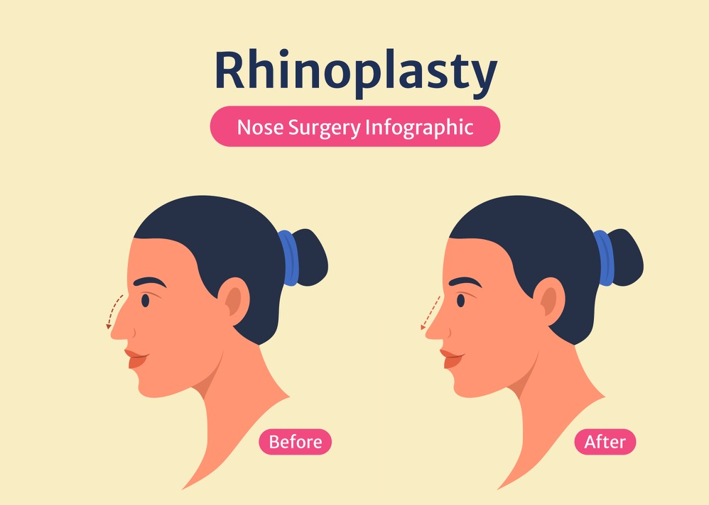 rhinoplasty-miami-price-recovery