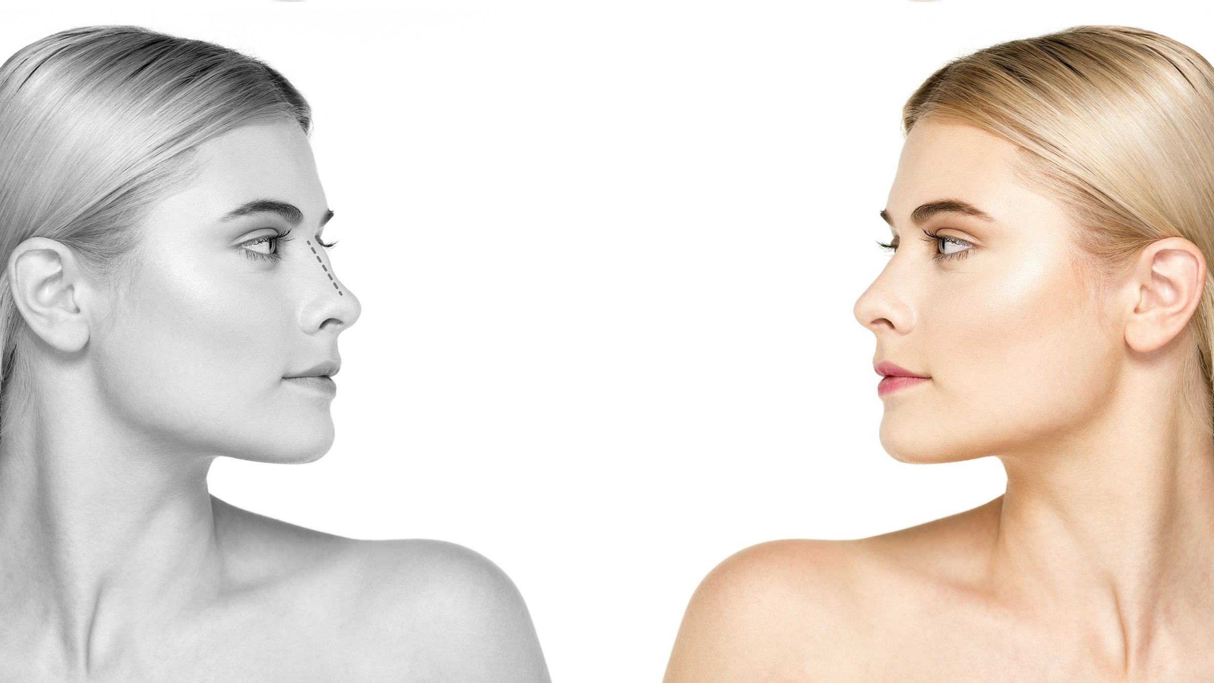 rhinoplasty-miami-price-recovery