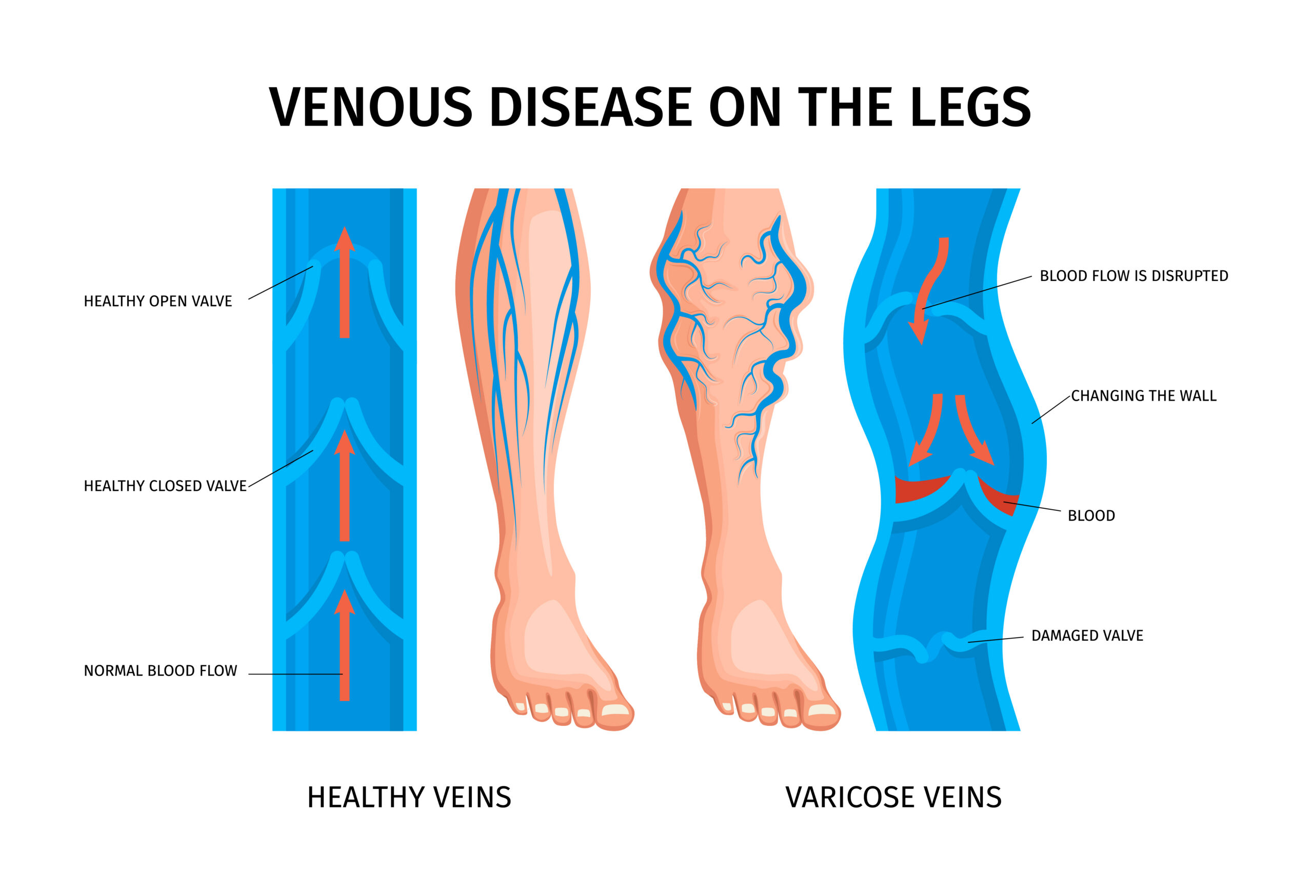 Venous disease diagram: healthy veins vs varicose veins Diagram comparing healthy vein valves and varicose veins, showing normal versus disrupted blood flow in the legs